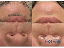 ベル(Belle)/【メンズ症例】肌悩みも解決