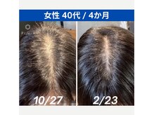 モア バイ リフェロ(moa by Refero)の雰囲気（40代女性の経過写真（4ヶ月経過））