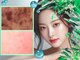 ウィア スキンサロン(Uvia skin salonk)の写真/剥離なしで即美肌になれると韓国でも話題！オルチャン肌管理【漢方ハーブピーリング】肌トラブル改善に抜群