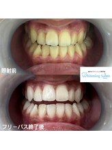 ホワイトニングサロン 熊本店/安いホワイトニング