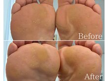 カシェット 広島店(Cachette)/60代女性☆足裏角質ケア90分