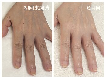 キレイテ 上野店/50代/6回目【ハンドケア上野】