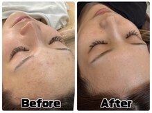 アンドエミニー エン ラボーテ(& EMINY 艶 la beaute)の雰囲気（当店でのケアを続けた結果！ニキビ肌が綺麗になりました！）