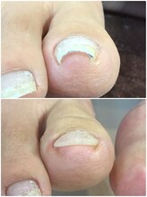 モアクリスタル(More Crystal)/巻き爪補正