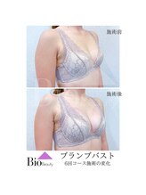 バイオビューティー 神戸本店(Bio Beauty)/プランプバスト　6回コース症例