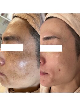 アンク(Ankh)/肌改善が得意です★オーナー担当