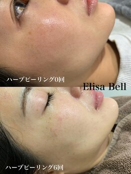エリーザベル(Elisa Bell)/ハーブピーリング