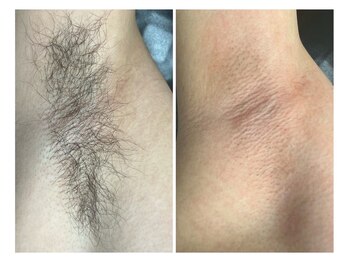 サロン ラズリ 久留米店(SALON Lazuli)/【わき脱毛】夏に間に合う！