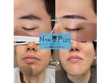 ノンプレックス(NON PLEX)