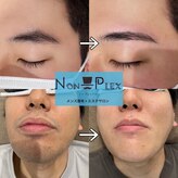 ノンプレックス(NON PLEX)