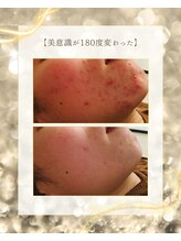 スノースキン(Snow skin)/ニキビケア/ハーブピーリング