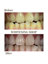 ホワイトニングショップ 銀座7丁目店(WHITENING SHOP)/Before After
