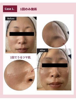 トータルサロン ヴィータ(VITA.)/白玉フェイシャルの効果が◎