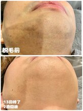 ワイズサロン(Y's salon)/ヒゲ脱毛13回終了別アングル