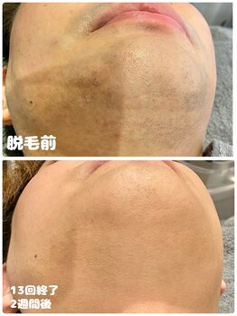 ワイズサロン(Y's salon)/ヒゲ脱毛13回終了別アングル