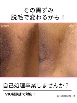 エイチケービューティーサロン(H/K beauty salon)/【脱毛×黒ずみケア】