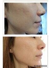 アゴラ/【小顔】ハーブピーリング１回目