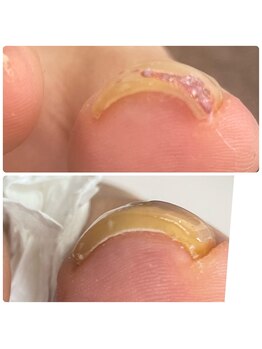 エクラプラス(Eclat.plus)/足爪の違和感…我慢しないで！