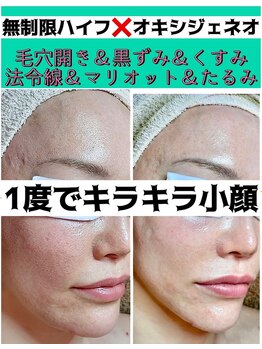 スペチアーレ 夙川/小顔だけでなく1度で肌質も激変