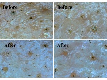 ハーシークレット(Her secret)/ハイドラ毛穴洗浄