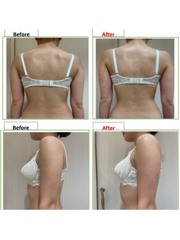 エステティック レイビス 銀座店(RAYVIS)/バストアップ