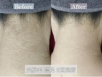 メリア 岡山駅前店(melia)/襟足 光脱毛