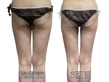 エリクシア 松戸/50代太もも集中リンパ痩身