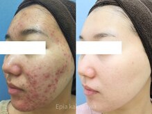 フェイシャル専門店 エピア 掛川店(Epia)の雰囲気（繰り返す頑固なニキビケアはお任せください！）