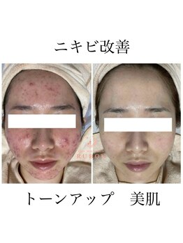 ルボン 宮崎店(RUBON)/RUBONのニキビケアエステ