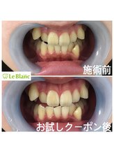 ルブラン 奈良店(Le Blanc)/八重歯も可愛く見える！