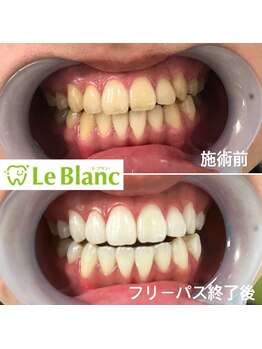 ルブラン 奈良店(Le Blanc)/白くしたい方！！