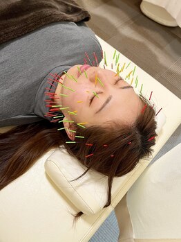 まごころ整骨院/効果絶大！百美鍼！！