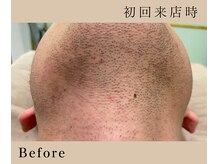 リノ(Lino)/人気のヒゲ脱毛