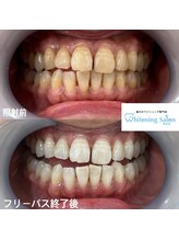 ホワイトニングサロン 熊本店/熊本市でホワイトニング