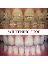 ホワイトニングショップ 徳島藍住店/Before After美白ホワイトニング