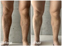 ボヌールデソワ(Bonheur de Soi)/全身脱毛