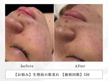 レッド(RED)/ニキビやシミ、しわにおすすめ