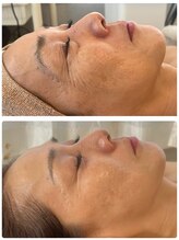 プリュボーテ(Pul Beaute)/凸凹肌改善コース