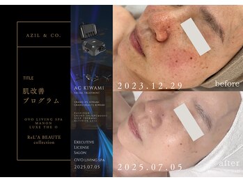 オーヴォ リビングスパ アネックス マノン(OVO LIVING SPA annex MANON)/【施術事例】肌改善プログラム