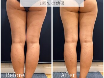 ブリリオ 池袋店(Brillio)/BODY◇lifit下半身×ラジオ波