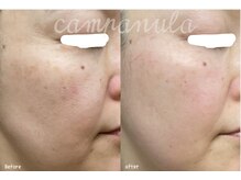 カンパニュラ(campanula)の雰囲気（40代からのたるみ毛穴お任せ◎毛穴・シミ・ニキビ・乾燥・くすみ）