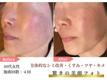 トレース/美顔フォトの効果（40代女性）