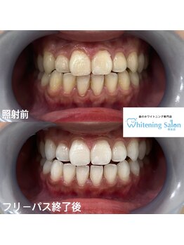 ホワイトニングサロン 熊本店/今からホワイトニング