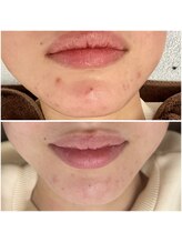 ヴィヴ コレビ(VIV COREBI)/男性ニキビのニキビケア赤み鎮静