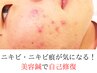 【ニキビ・陥没肌】美容鍼が肌の修復力を引き出す♪ カウンセ込40分