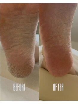 おん/ガサガサ踵