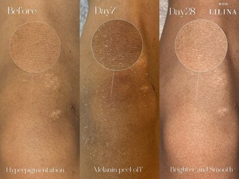 ウィズリリナ 新横浜(with Lilina.)/ローマピンク 症例　途中経過