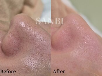 サンビ(SANBI)/しぶとい黒ずみ毛穴もスッキリ！