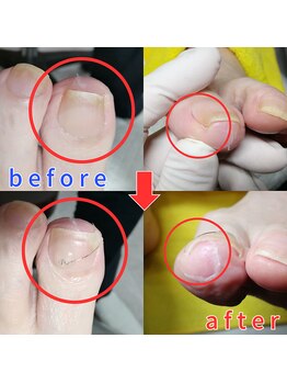 【巻き爪】ネイル/フット