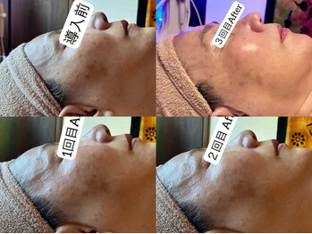 温和活 ロータス(温和活Lotus蓮:)/毛穴ハイドロ&美容液導入